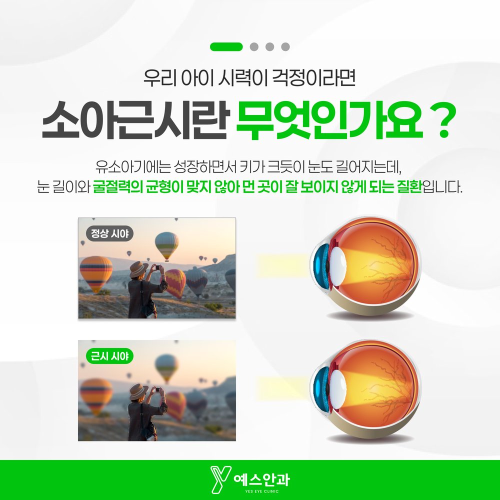 소아근시란 무엇인가요?
