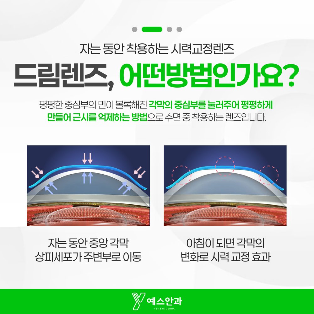 드림렌즈, 어떤방법인가요?