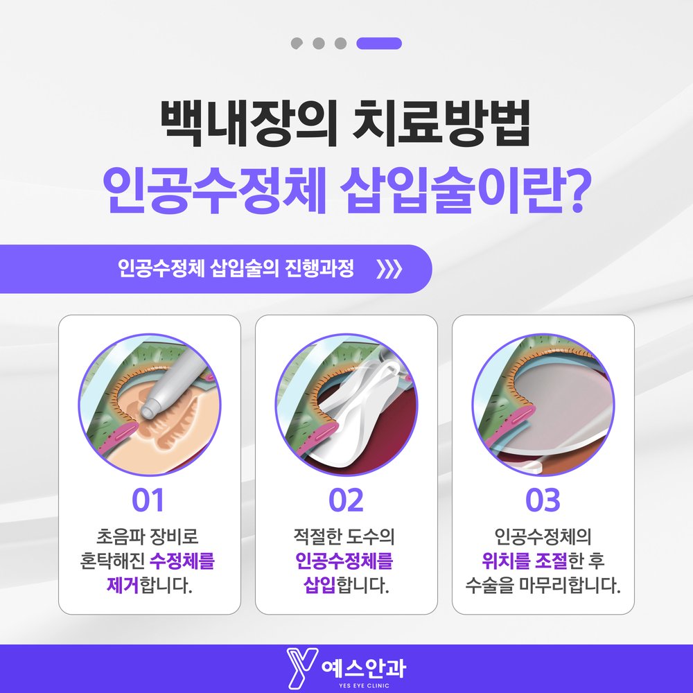 인공수정체 삽입술이란?