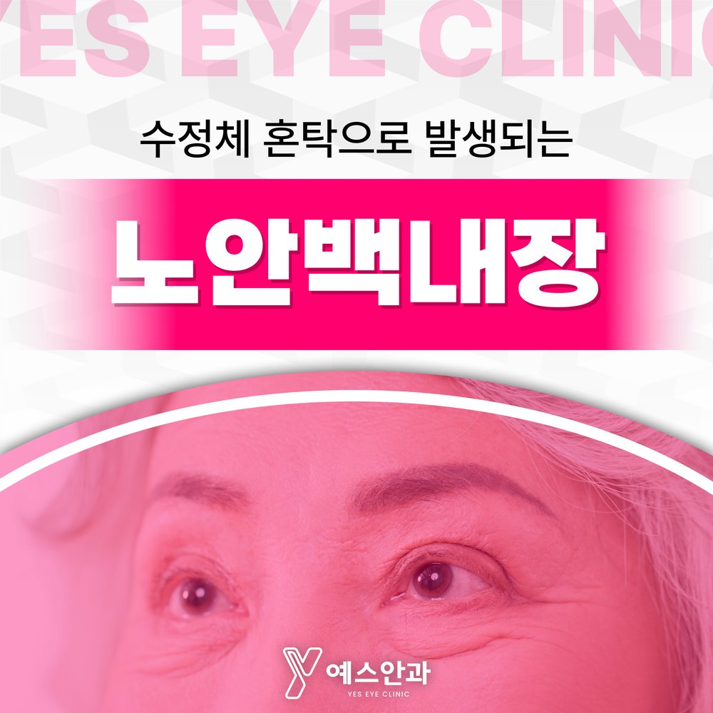 수정체 혼탁으로 발생되는 노안백내장