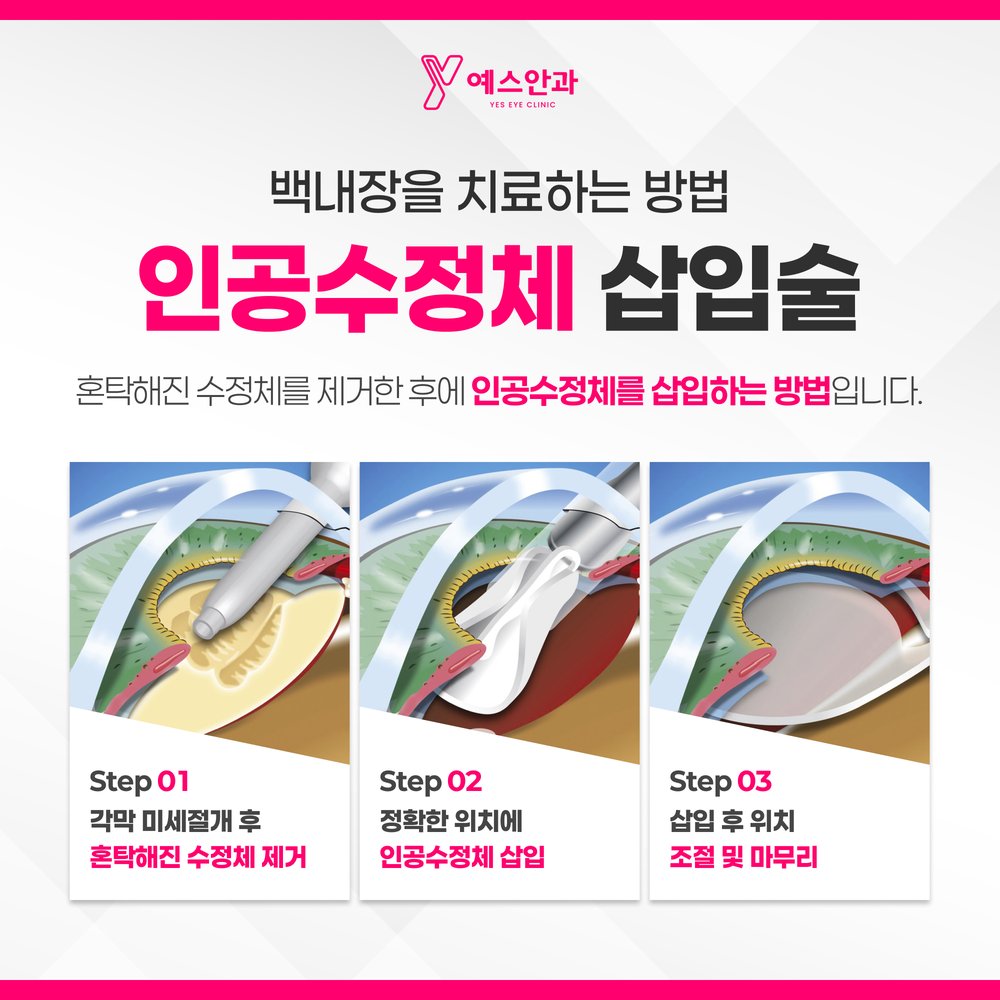인공수정체 삽입술